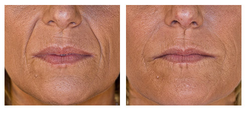 juvederm-04.jpg